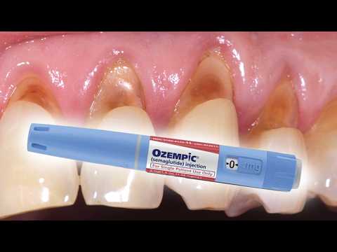 Is Ozempic Shrinking Both Your Waistline and Gumline!?