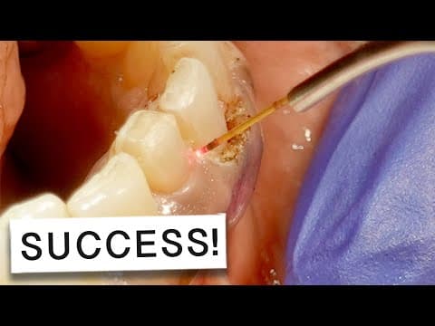 Laser Gum Surgery Success Story: INCREDIBLE Outcome! 🤩
