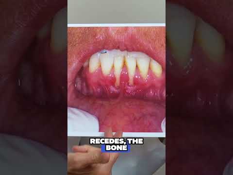 Invisalign: Unveiling the Hidden Risks #gumrecession #shorts