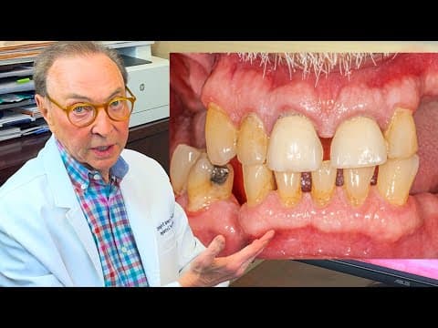 Most Dentists Would REMOVE ALL His Teeth and Bone 😶 Is There a Better Way?