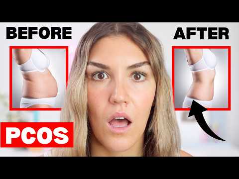 What Causes PCOS and How to Reverse It (For Good!)