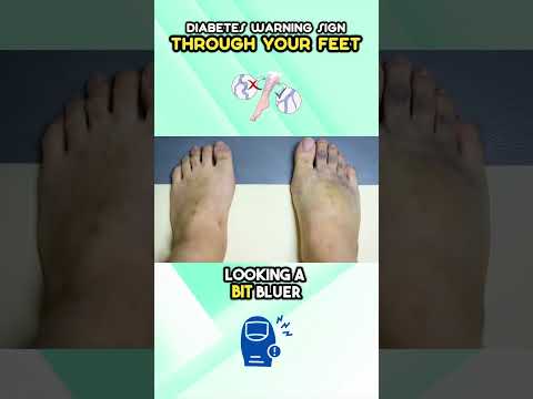 Diabetes Warning Sign through your Feet
