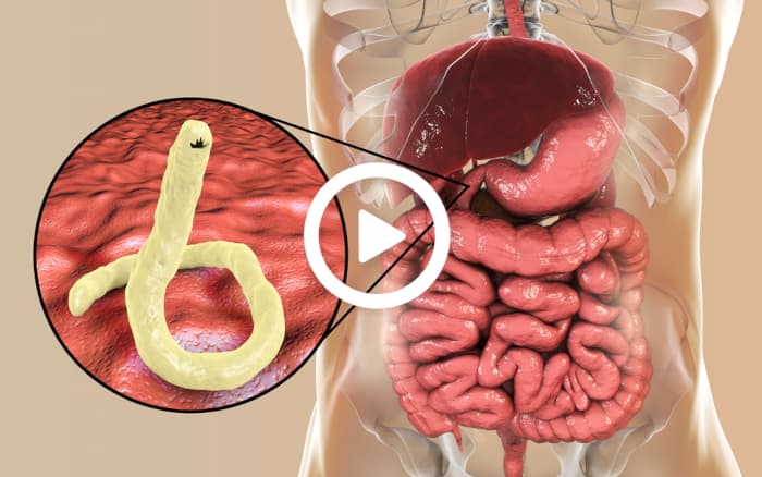 4 Signs That Parasites Are Living In Your Body (See The Symptoms)